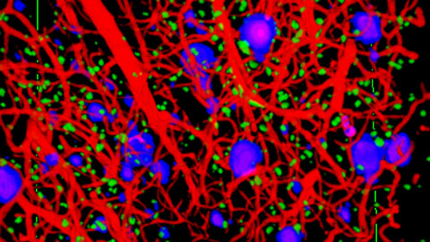 Geometría contra el Alzheimer