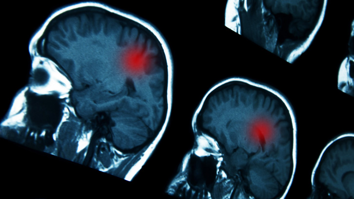 MRI per diagnostic tumor cerebral