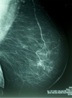 Mamografies