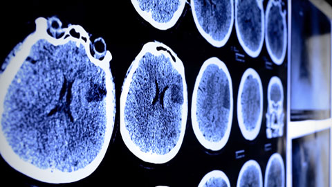 Imatge radiològica d'infart cerebral