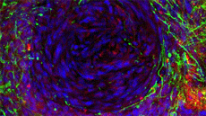 glioblastoma