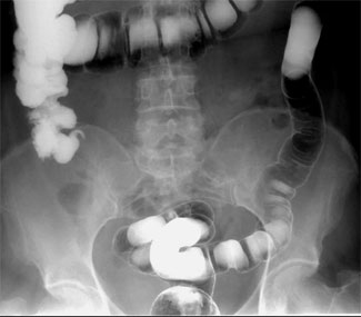 Colorecto