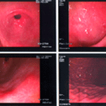 Colitis i malaltia de Crohn