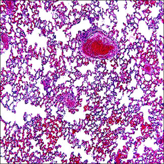 Microfotografía d'un pulmó afectat de tuberculosi.