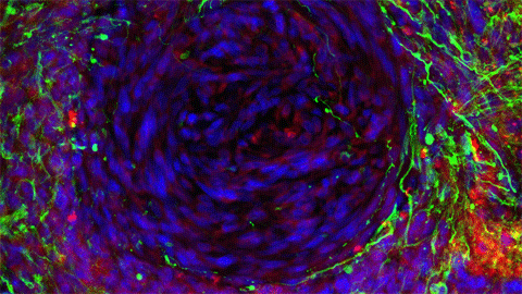 glioblastoma