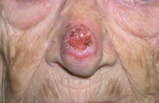 Carcinoma basocel·lular