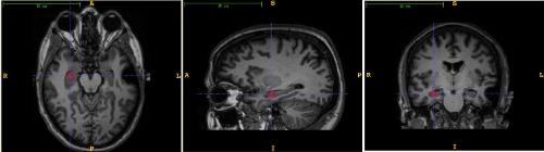 escàner cerebral síndrome cushing