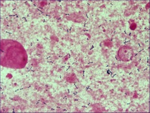 Deteccio Pneumonia Orina