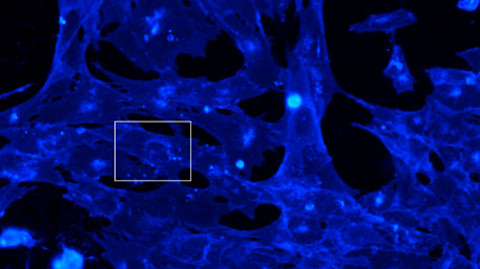 Astròcits APOE4 en cultiu amb una alteració de lípids