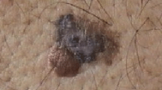 Melanoma Maligne