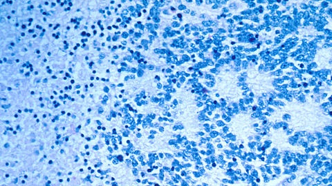 Neuroblastoma