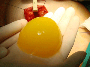 Gel de plaquetes