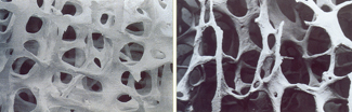 Osteoporosi