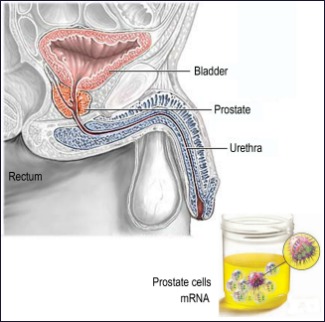 Biomarcadors Càncer Pròstata
