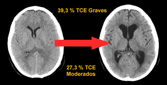 Dilatacions al cervell