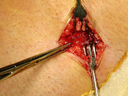 Extracció de l'implant