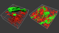 Biòpsies de Gliobastoma en 3D