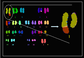 Diagnostics més precisos gràcies a noves tècniques de citogenètica molecular