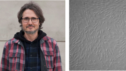 Descobreixen alteracions bioquímiques en els pacients amb la malaltia de Lesch-Nyhan