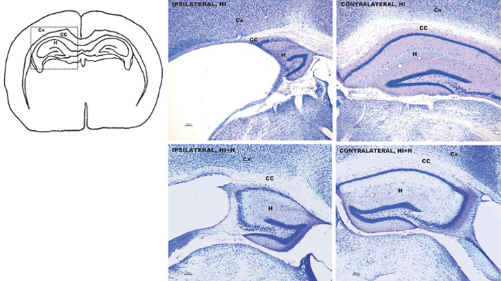 perinatalhypocxic