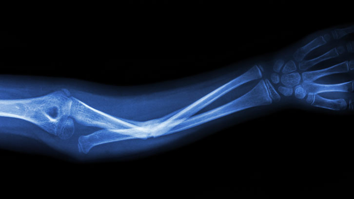 fractures per fragilitat nova