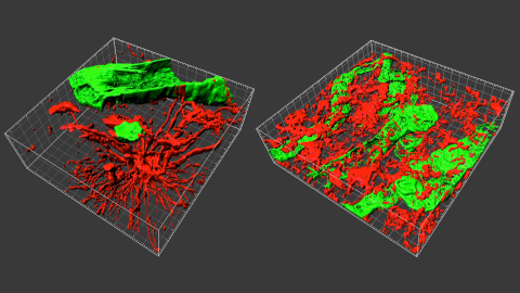 Biòpsies de Gliobastoma en 3D