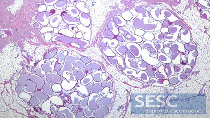 cistomatosis