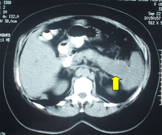 Imatge d'un tumor de pàncrees