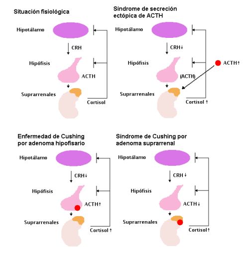 Síndrome de Cushing