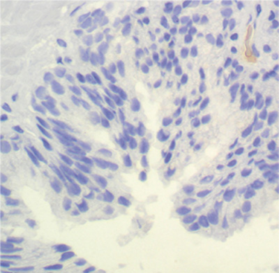 neoplasia intraepitelial prostatica (pin) de alto grado neoplasia intraepitelial prostatica (pin) de alto grado