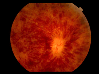 Oclusió de vena central de la retina.