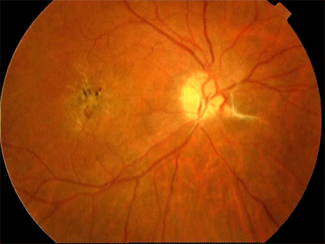 Oclusió de vena central de la retina.