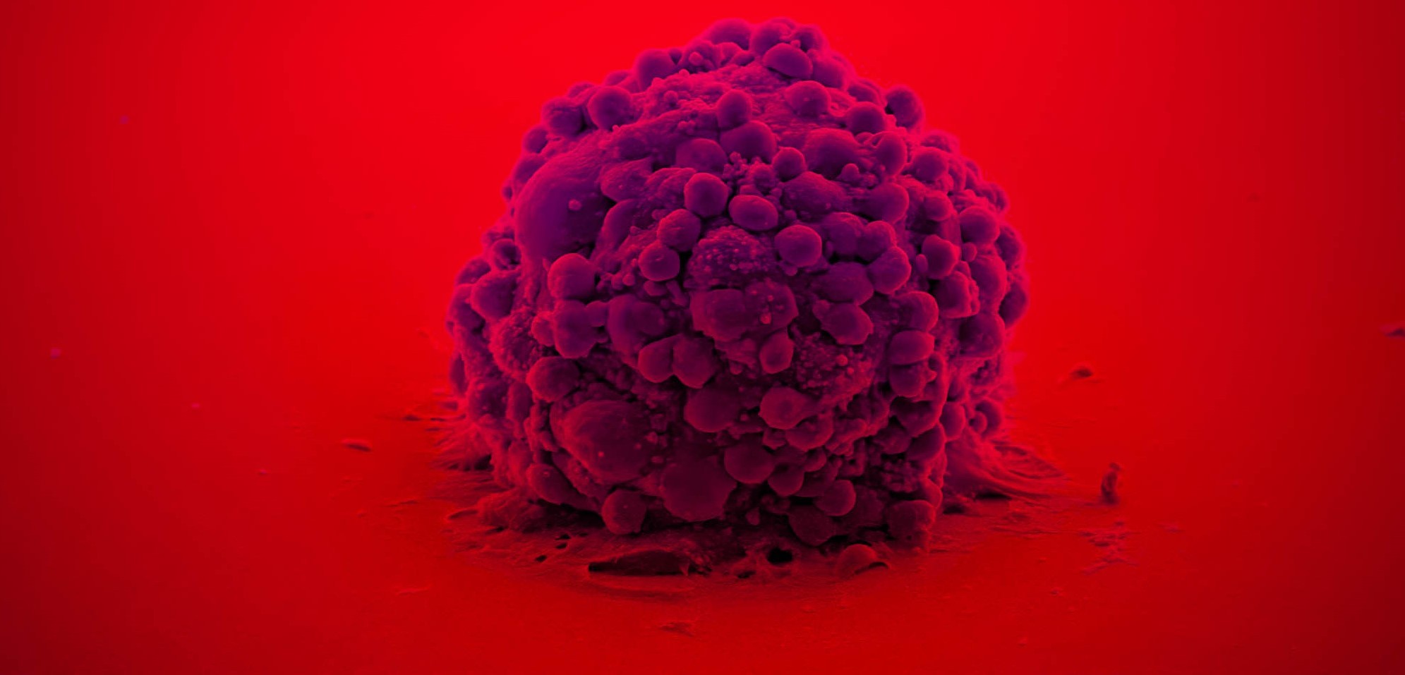 IG_NOT_260202_glioblastoma (en)