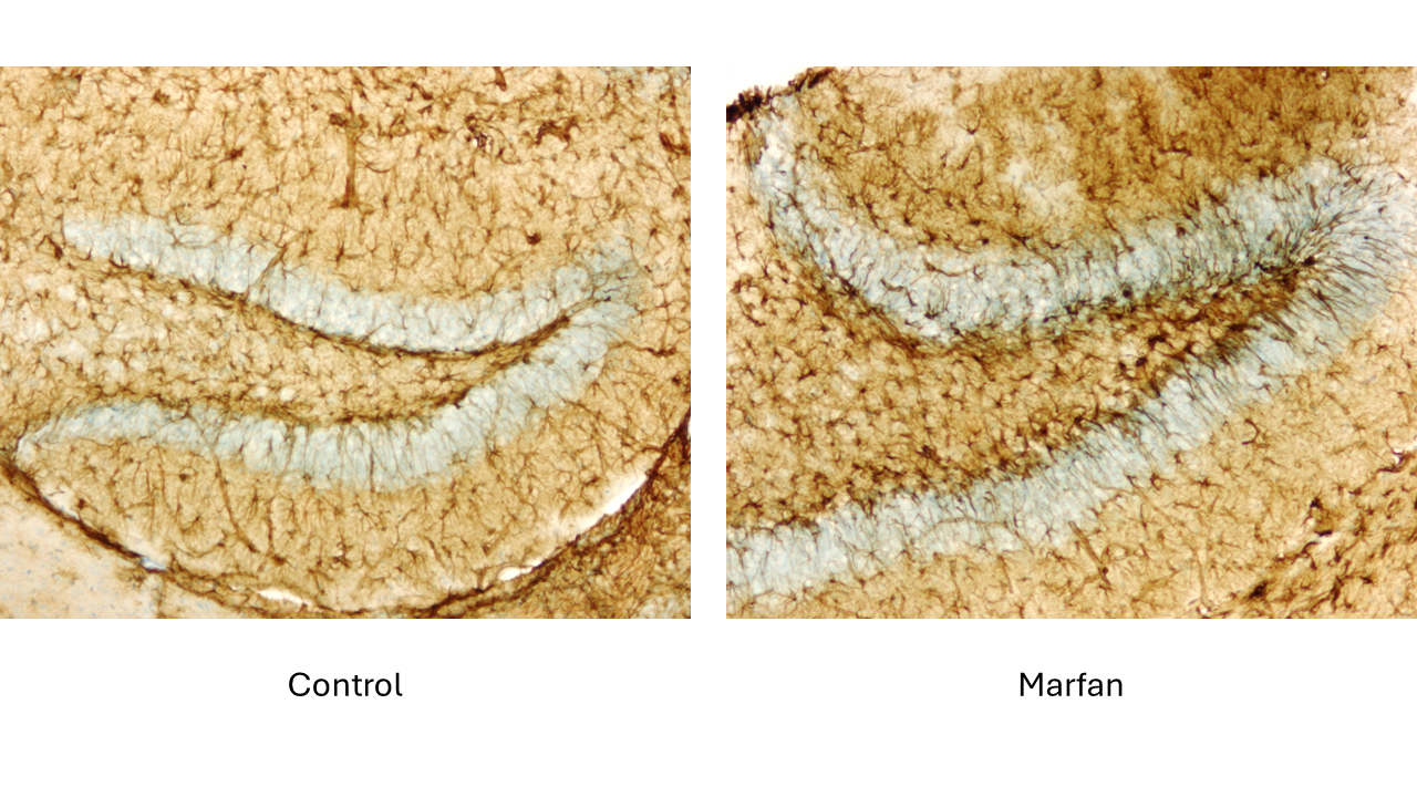 Marfan-en